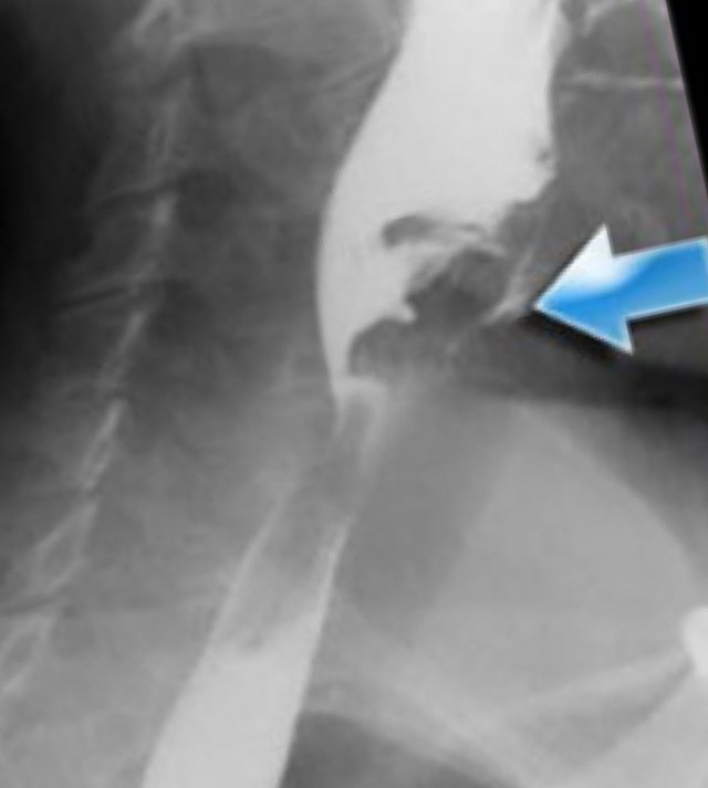 Asymmetric swallowing  due to head turn. The head is turned to the left and contrast is only seen in the right food channel.