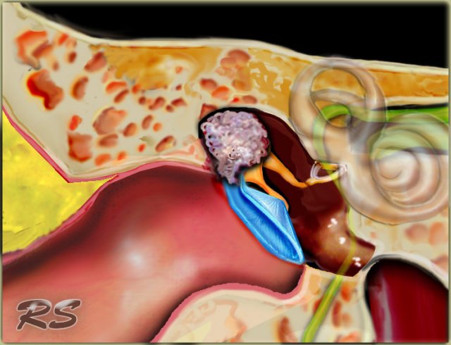 Illustration of a cholesteatoma