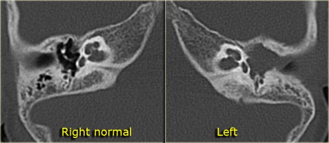 Automastoidectomy due to a large cholesteatoma