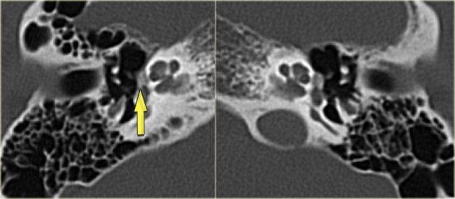 Bilateral otosclerosis