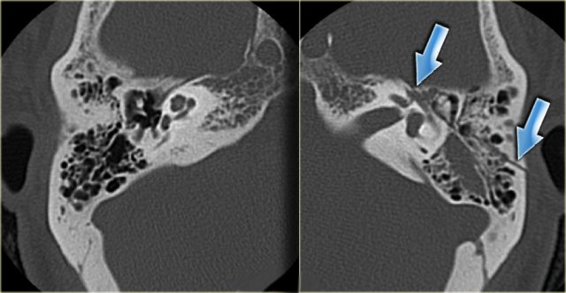 Sensorineural hearing loss due to longitudinal fracture (arrows)