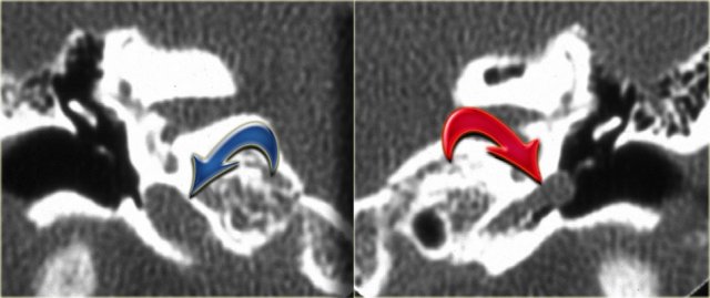 Aberrant internal carotid artery  (courtesy of Hervé Tanghe)