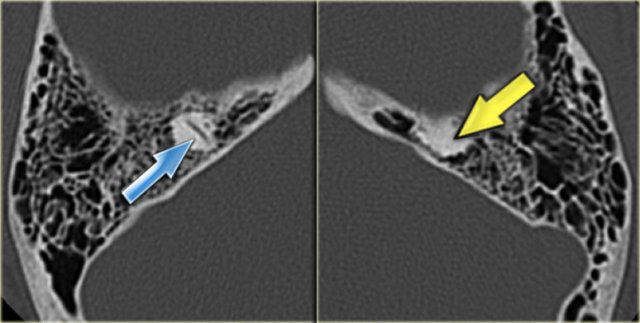 Labyrinthitis ossificans of the left superior semicircular canal (yellow arrow)