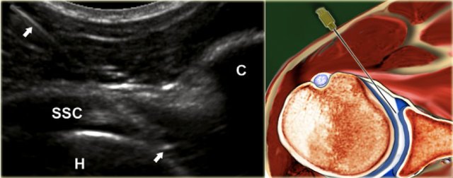 The landmarks one should look for are the medial contour of the humeral head and medial to this the coracoid process (C)