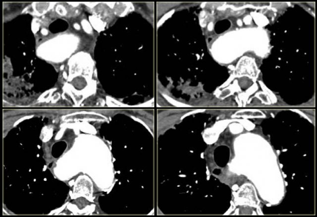 Dysphagia lusoria in patient with dilated aberrant right subclavian artery.