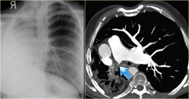 Pulmonary agenesis on the right side