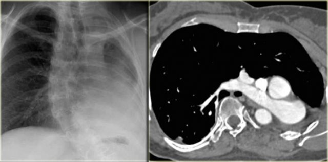 Pulmonary agenesis on the left side