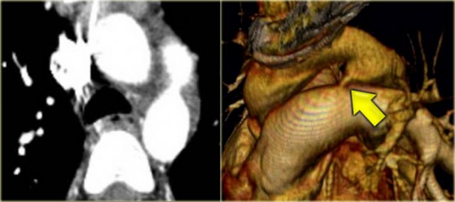 Patent Ductus Arteriosus