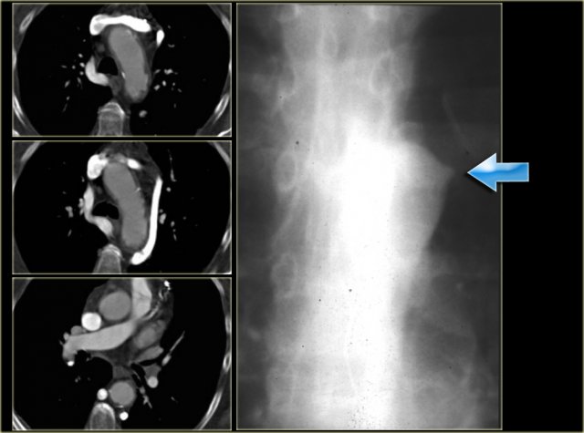 Left Superior Intercostal Vein